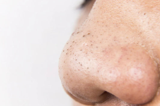 What's Clogging Up Your Pores?